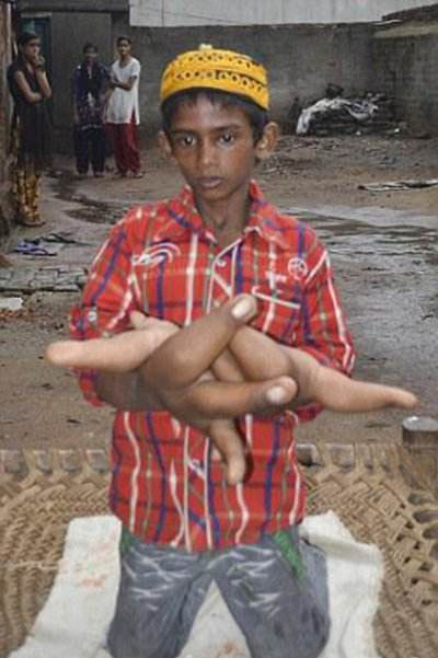 印度8岁男孩长巨手 什么叫一掌拍死你