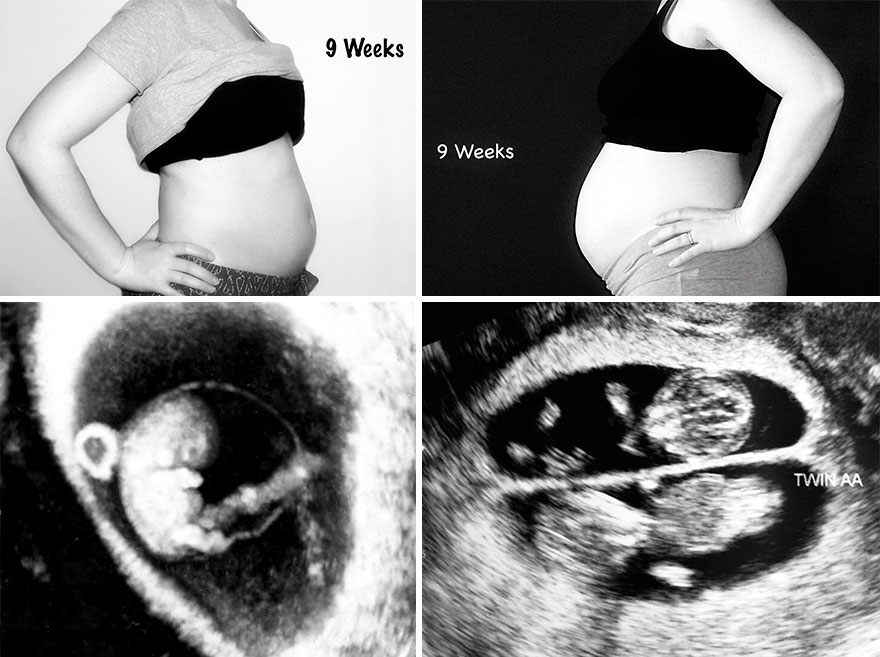 女人怀一个孩子和怀双胞胎 肚子有何不同？
