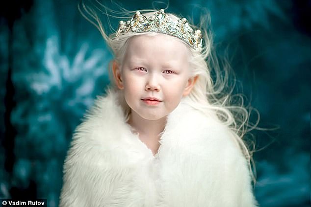 俄罗斯8岁白化病女孩梦想当模特