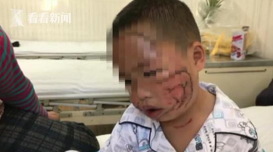 3岁男童遭哈士奇撕咬 满脸被撕烂缝合200多针