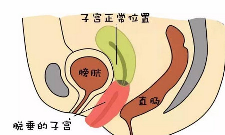 揭秘：女人子宫最怕的事！还有什么比人流更可怕？