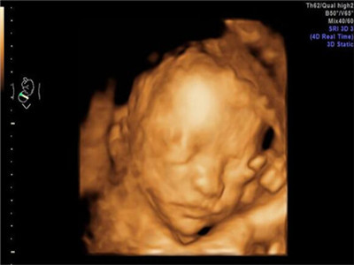 彩超对胎儿有影响吗  彩超辐射有多大?