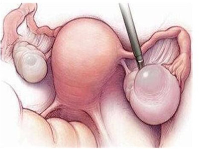 人工受孕是什么意思 人工受孕的注意事项