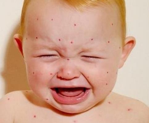 宝宝眼睛被蚊子咬了怎么消肿 夏季驱蚊妙招大全