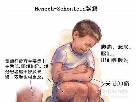 小儿过敏性紫癜的症状与表现 宝宝过敏性紫癜该如何预防