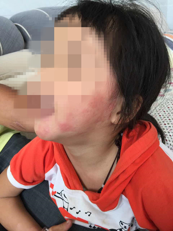 三星手机爆炸 贵州女童被烧伤遇索赔难