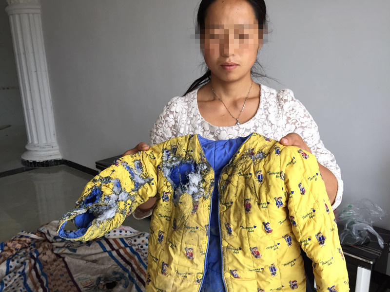 三星手机爆炸 贵州女童被烧伤遇索赔难