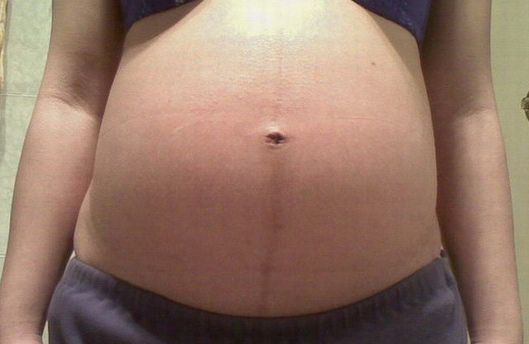 怀女宝的妊娠线图片