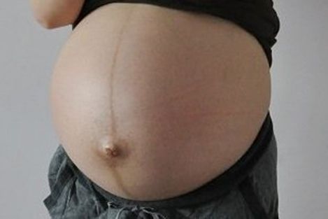 怀女宝的妊娠线图片