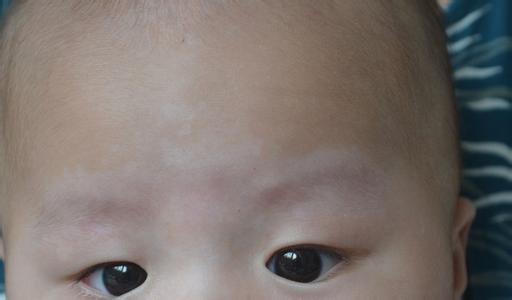 婴儿汗斑图片