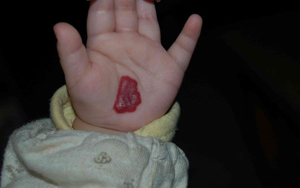 婴儿血管瘤初期图片
