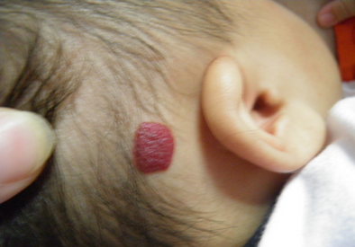 海绵血管瘤宝宝图片