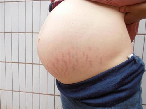 孕妇妊娠纹图片