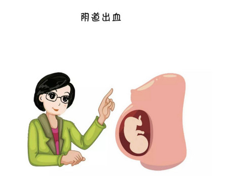 孕期来月经你遇到过吗？用月经来鉴别怀孕靠谱吗？