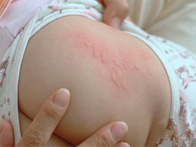婴儿荨麻疹图片