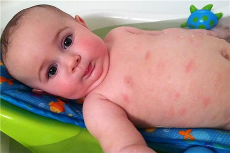 婴儿荨麻疹图片