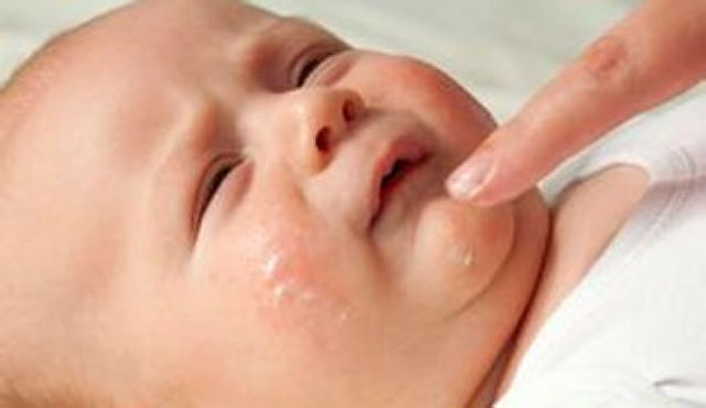 婴儿奶癣图片