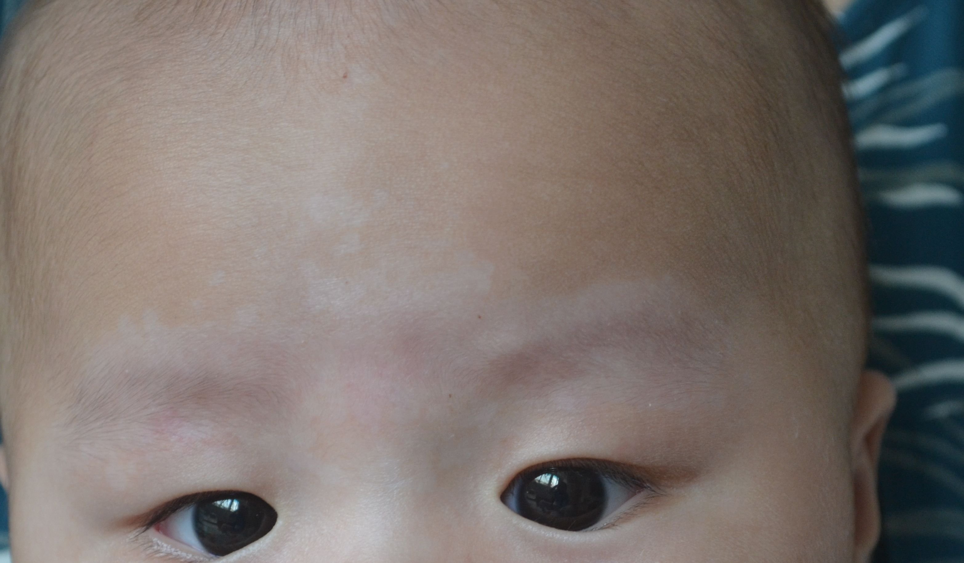婴儿白斑图片