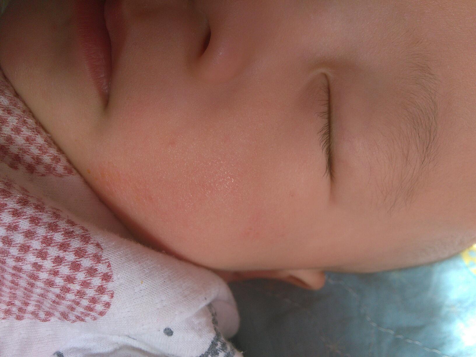 婴儿白斑图片