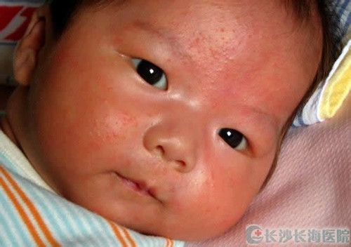 婴儿风疹图片