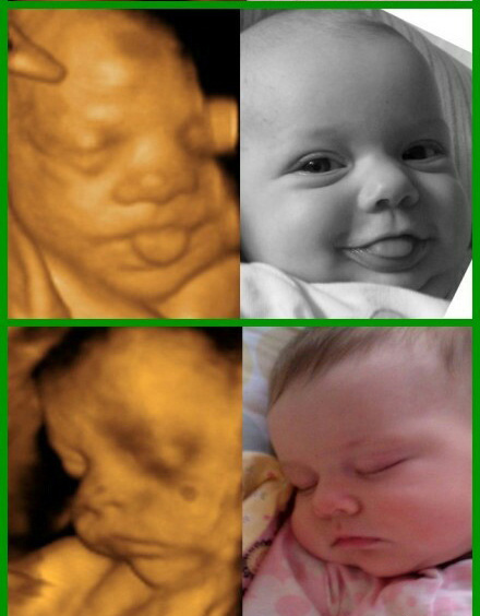 胎儿四维B超影像与宝宝出生后对比图 很神奇啊