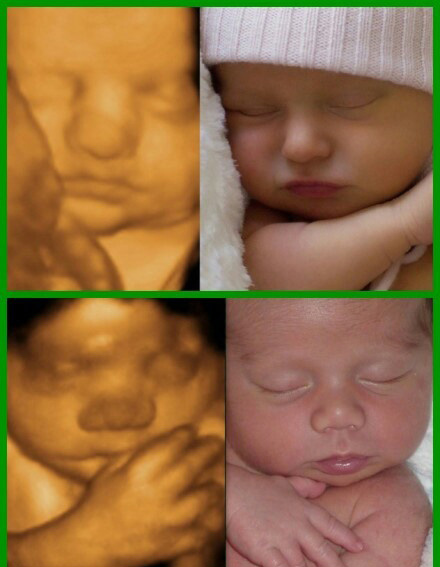 胎儿四维B超影像与宝宝出生后对比图 很神奇啊