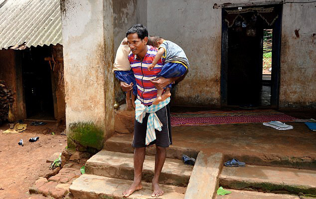 印度2岁连体宝宝有望分离