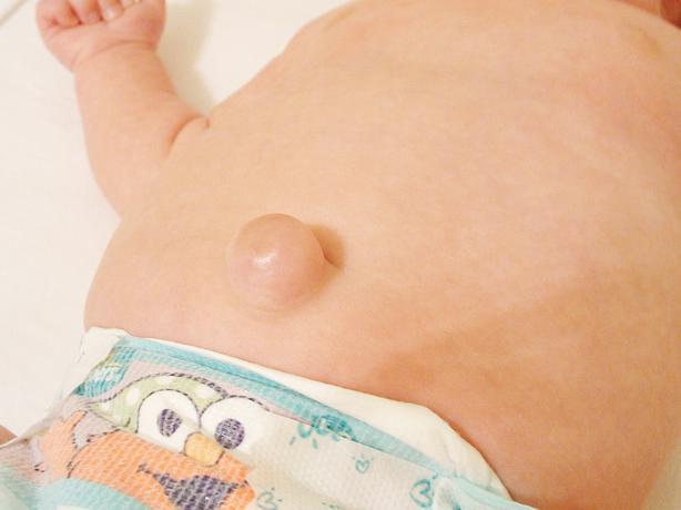 婴儿脐疝图片
