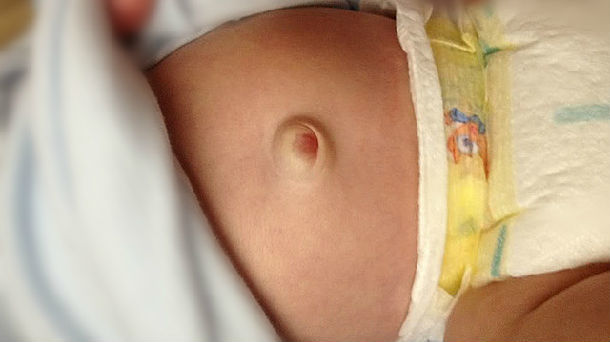 婴儿脐疝图片