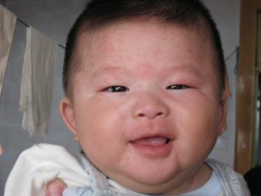 婴儿汗疱疹图片