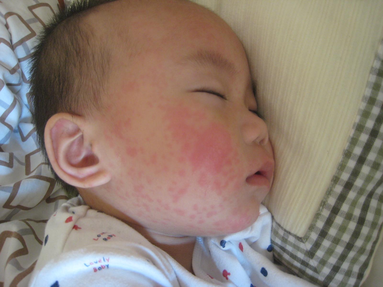 婴儿汗疱疹图片