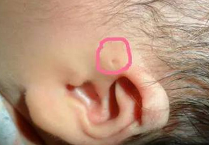 宝宝耳朵旁边的小洞是什么？如何预防感染？