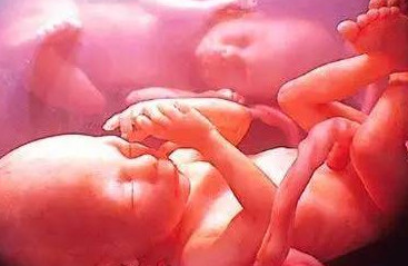 孕26周照四维彩超发现胎儿脐带打结，我该怎么办？