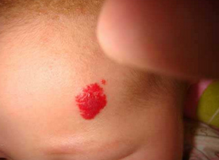 宝宝身上为什么会出现草莓状血管瘤，它的起因是什么