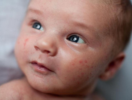 宝宝身上哪些疹子需要治疗，哪些疹子不需要呢？