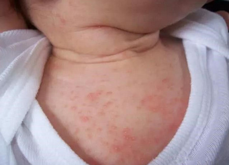 婴儿粉刺和湿疹有什么区别？