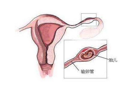 【宫外孕】宫外孕有哪些症状_宫外孕怎么办