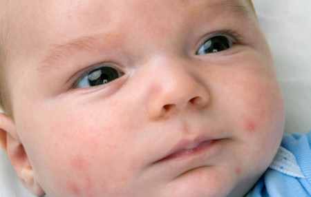 牛奶过敏的宝宝该如何喂养？专家给您最全面的解读！