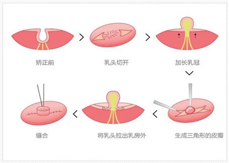 乳头内陷没有奶怎么办 这些办法让你不烦恼