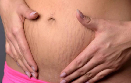 想要消除产后妊娠纹？这8个小技巧你得试试！