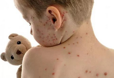 水痘是一种传染性极强的疾病，不想宝宝中招该如何预防？