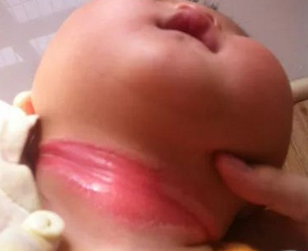 寶寶淹脖子發紅又破皮，寶媽知道該怎么辦嗎？
