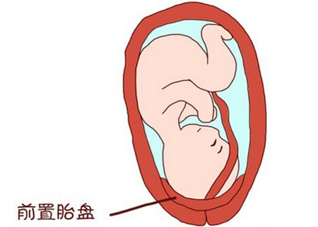 人流、剖宫产后再生育，小心前置胎盘