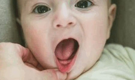 三岁多的宝宝患上了地图舌，到底应该怎么治？