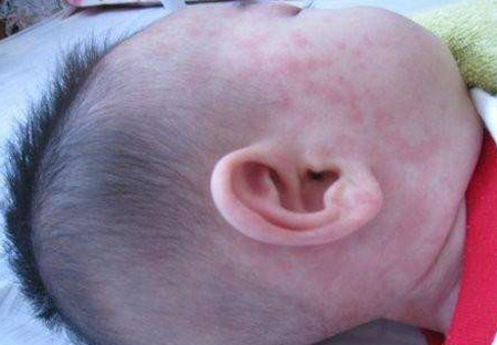 冬天宝宝也容易长疹子和痘痘吗？