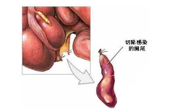 小儿急性阑尾炎手术多少钱