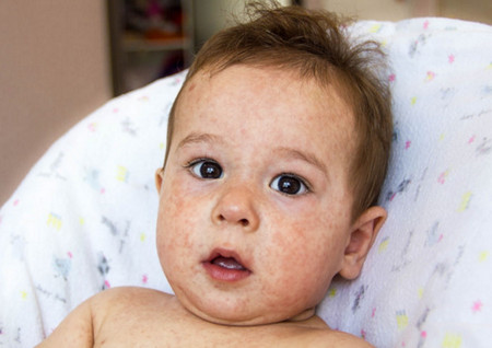 满月宝宝湿疹如何防治？
