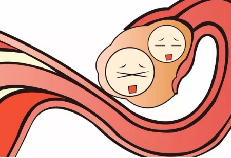 备孕二胎取环需要注意什么呢？