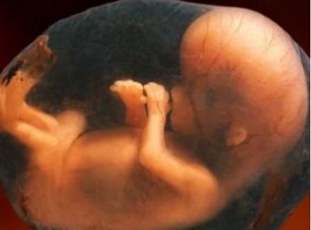 27周胎儿查出“足内翻”，还能要吗？