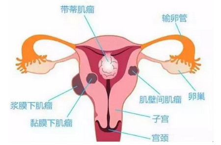 子宫肌瘤患者的饮食宜忌！